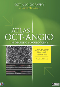 Atlas OCT Angiography in Diabetic Maculopathy