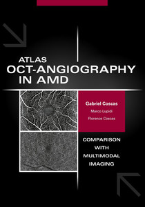 Atlas OCT Angiography in AMD